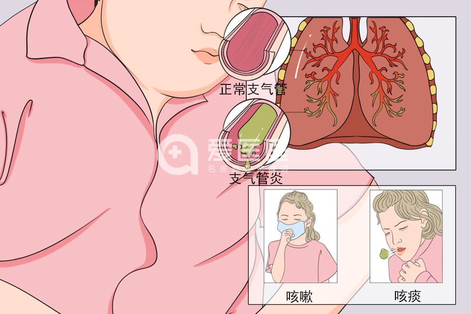 支气管炎