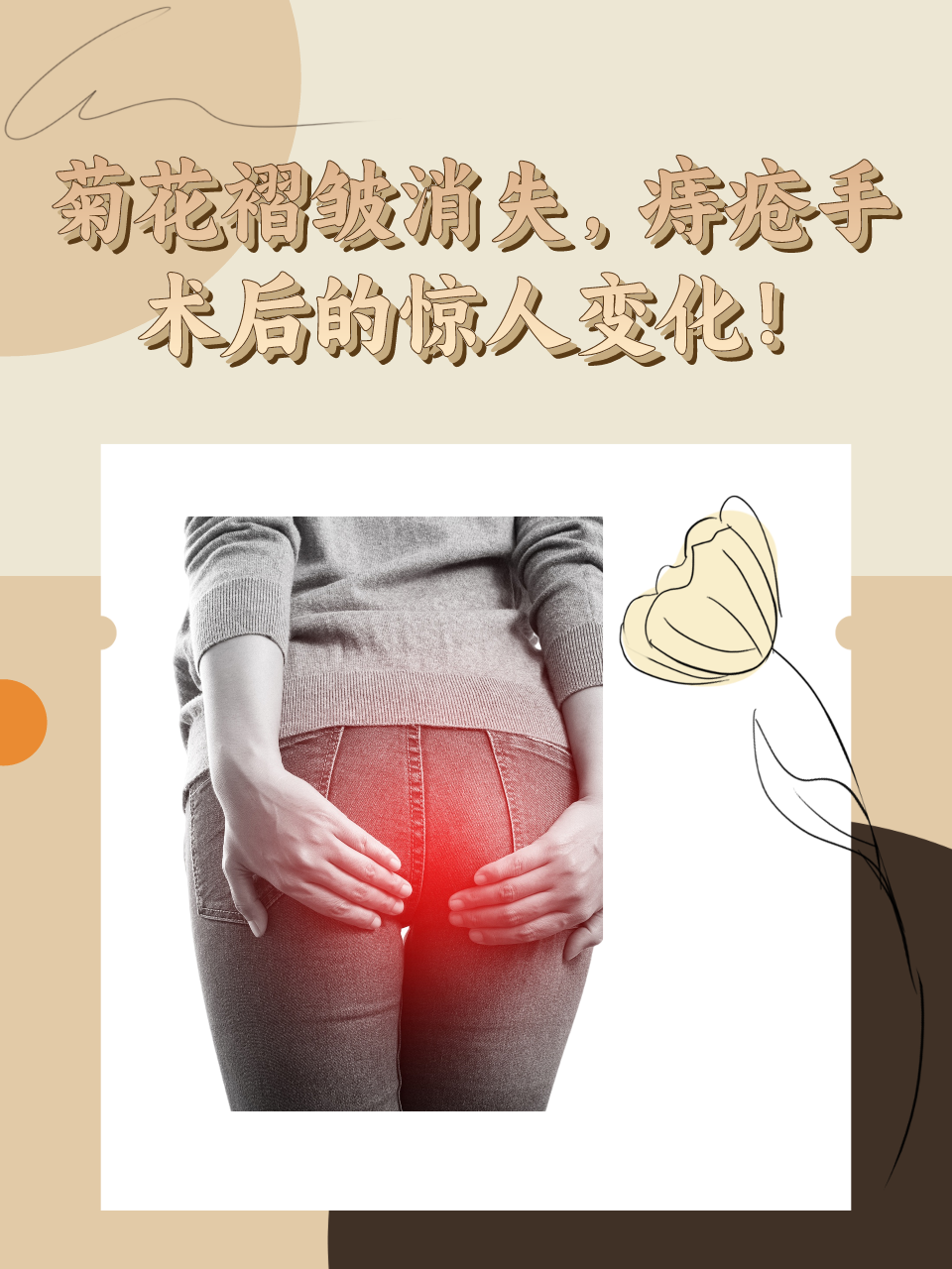 菊花褶皱消失，痔疮手术后的惊人变化！