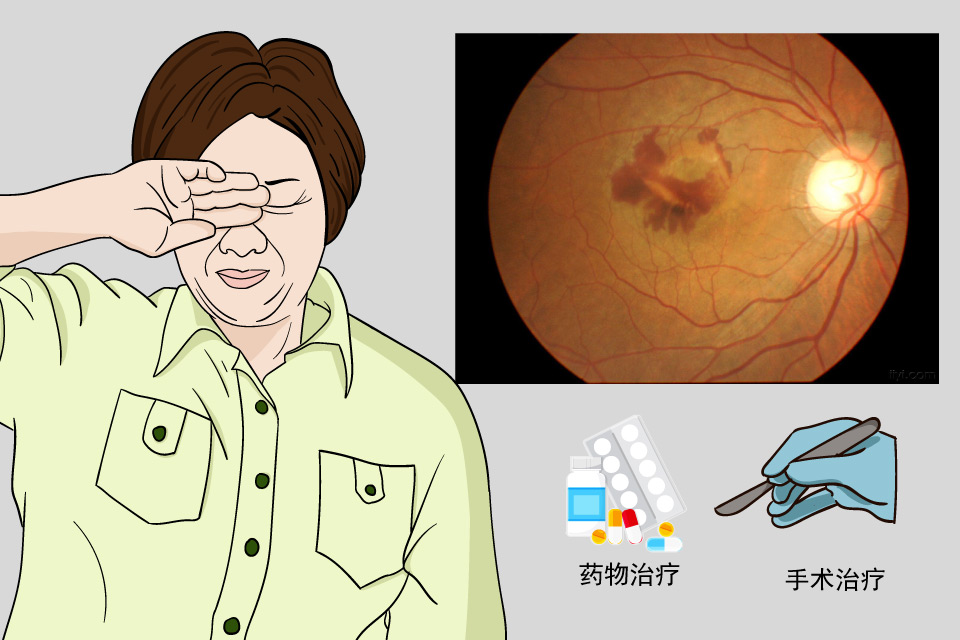 黄斑变性
