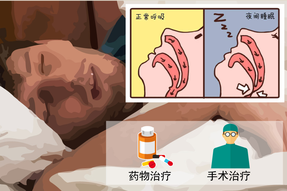 阻塞性睡眠呼吸暂停低通气综合征