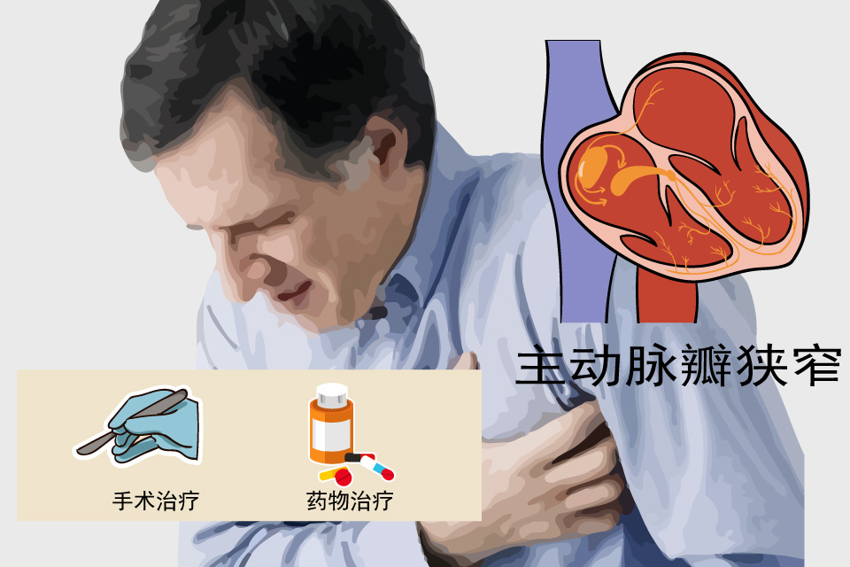 主动脉瓣狭窄
