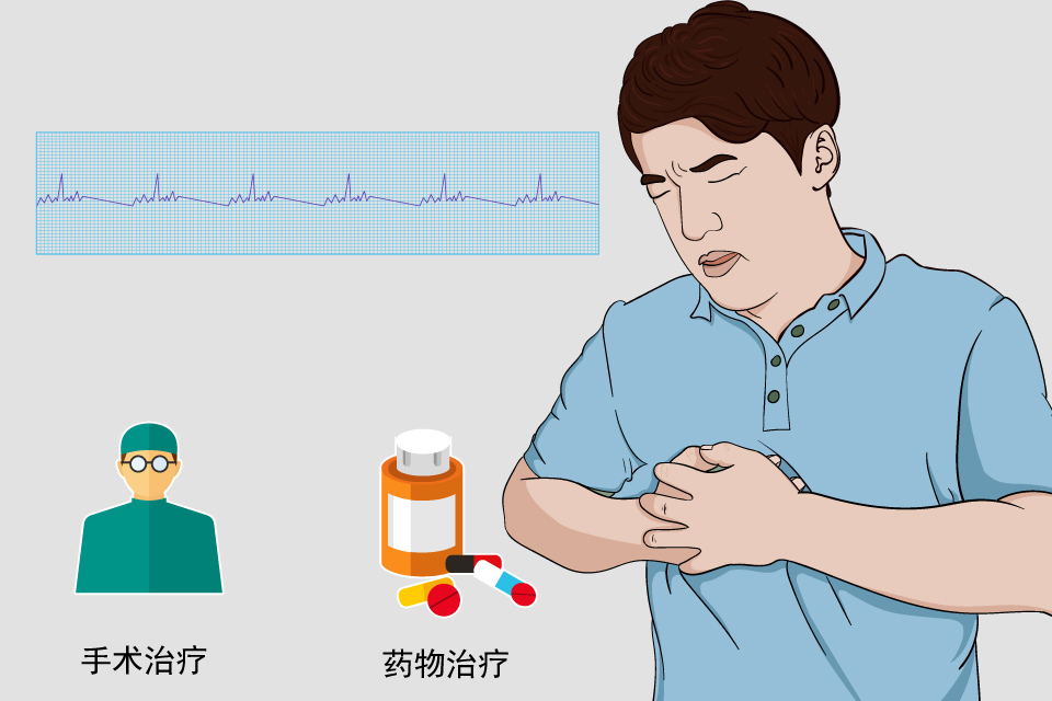 室性期前收缩