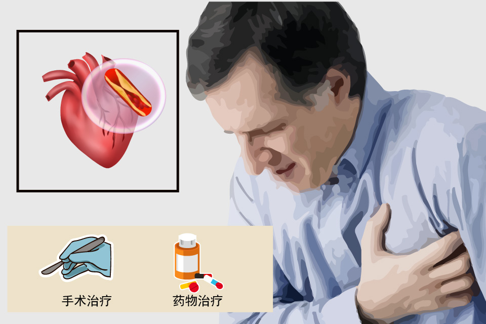 急性冠状动脉综合征