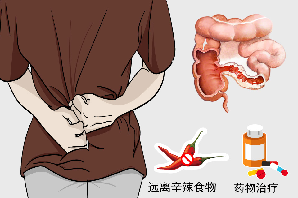 大肠息肉