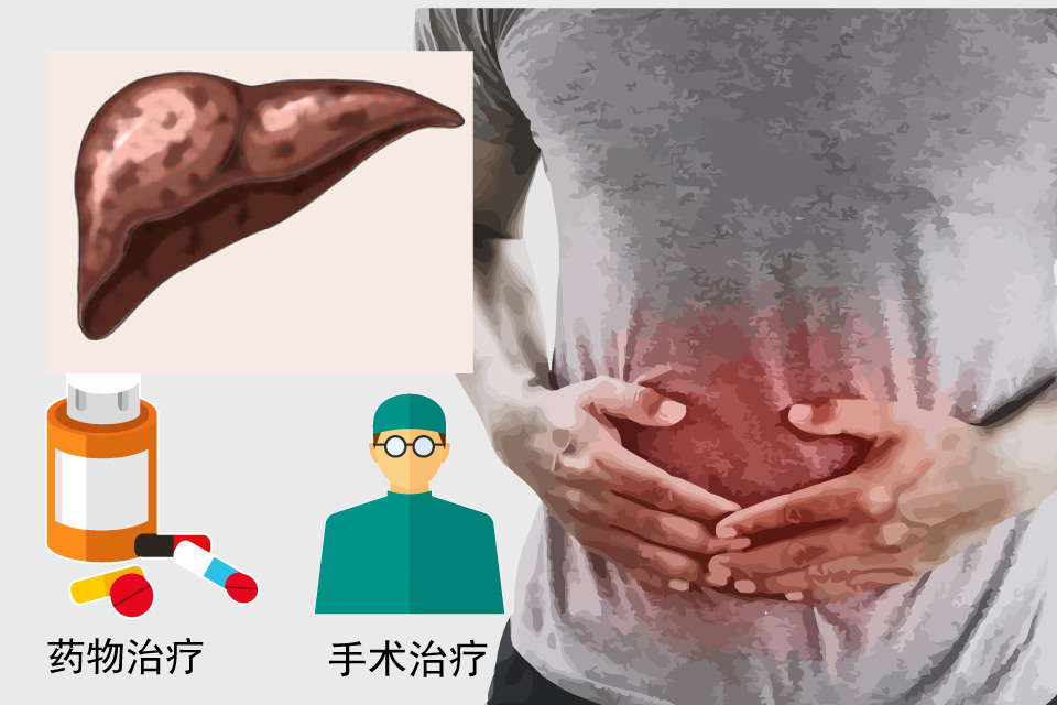 酒精性肝病