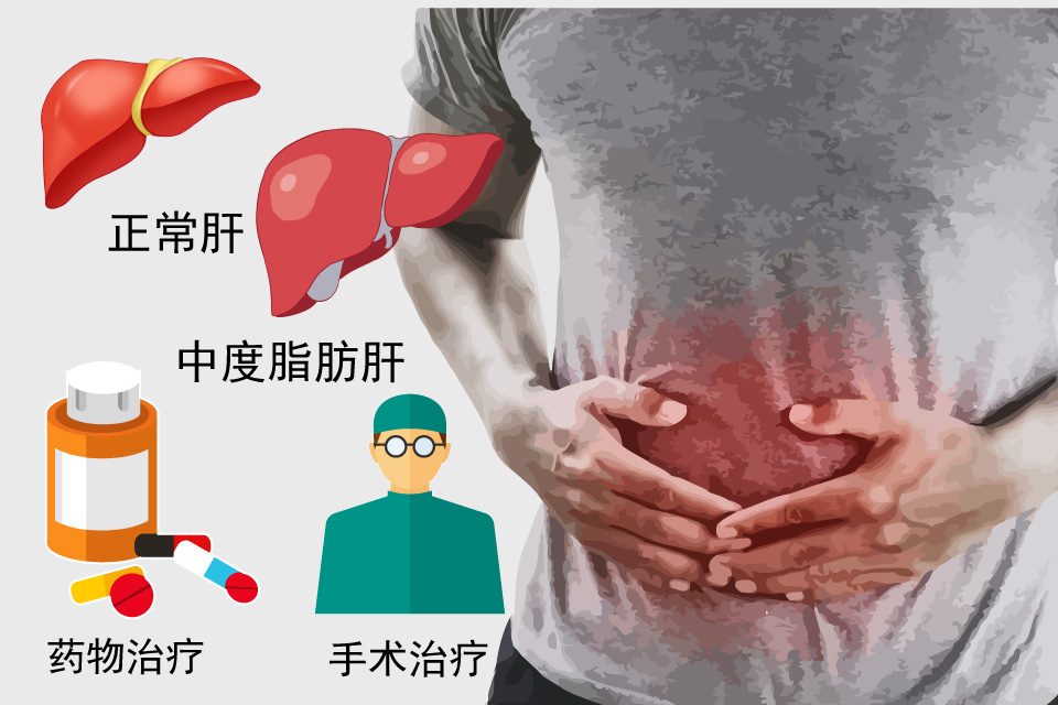 中度脂肪肝