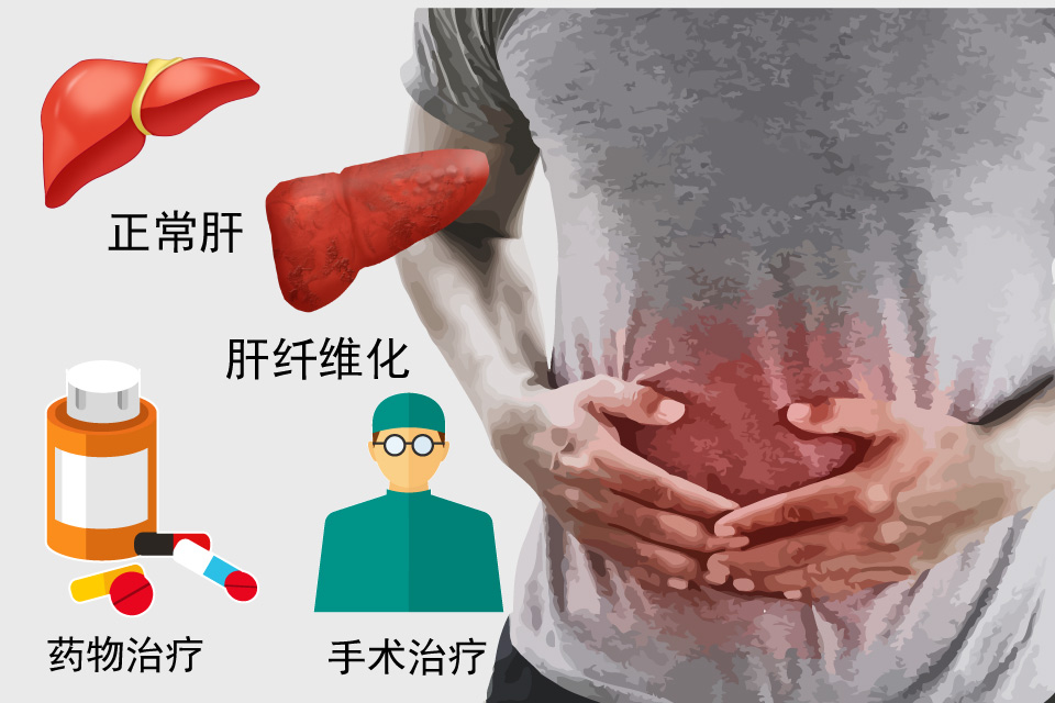 肝纤维化
