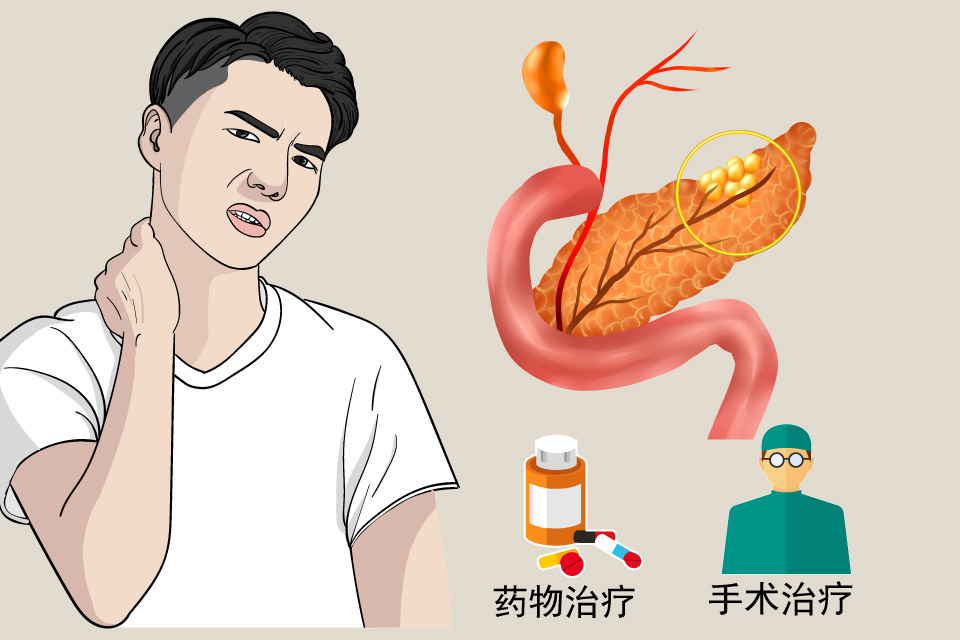 胰岛细胞瘤